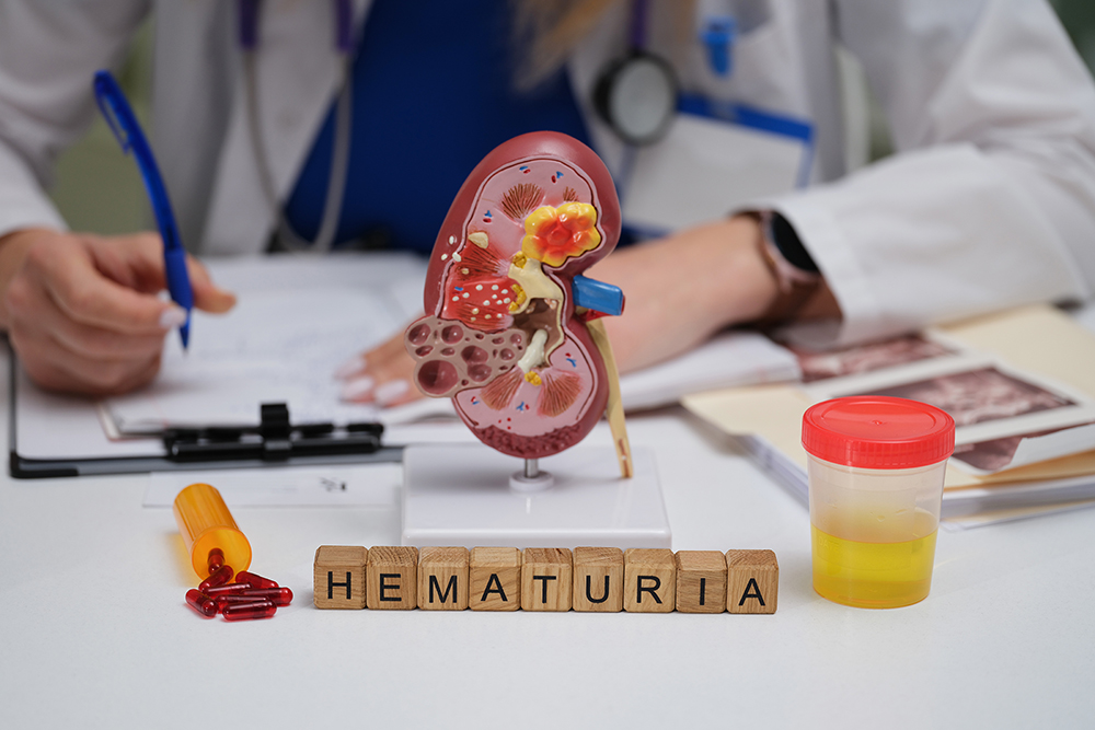 A doctor studying the causes of hematuria