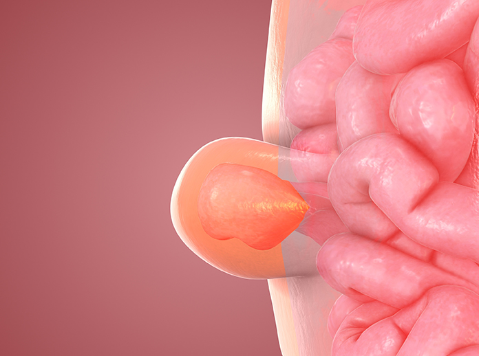 Inguinal hernia in abdominal area