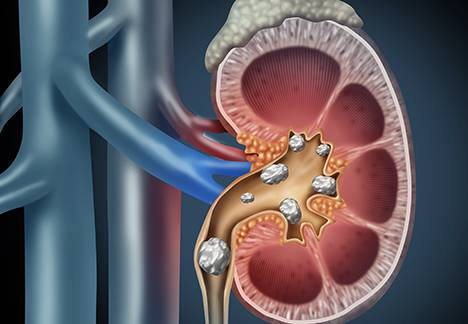 Specialised Urological Services - Urinary (Kidney) Stones