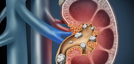 Specialised Urological Services - Urinary (Kidney) Stones