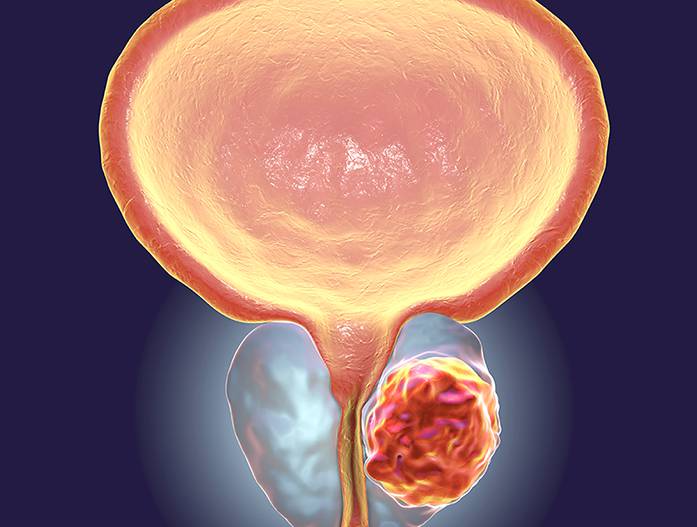 Prostate Conditions, Treatment, & Procedures