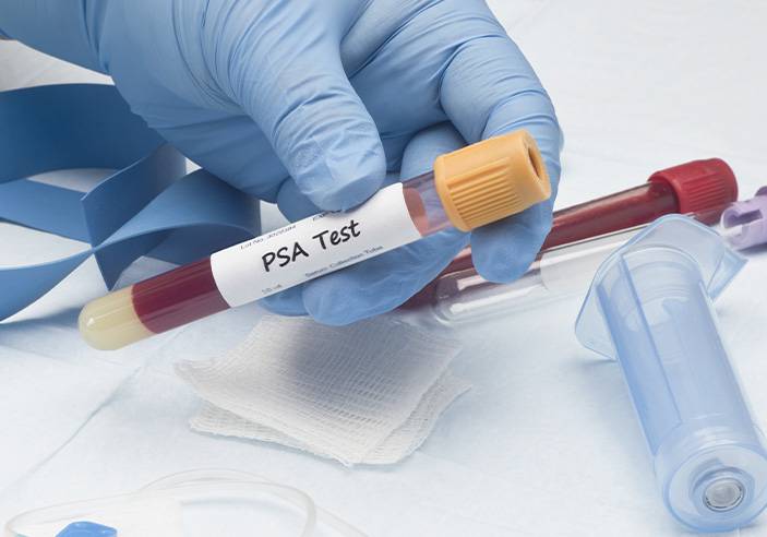 Prostate-Specific Antigen (PSA) Test Singapore