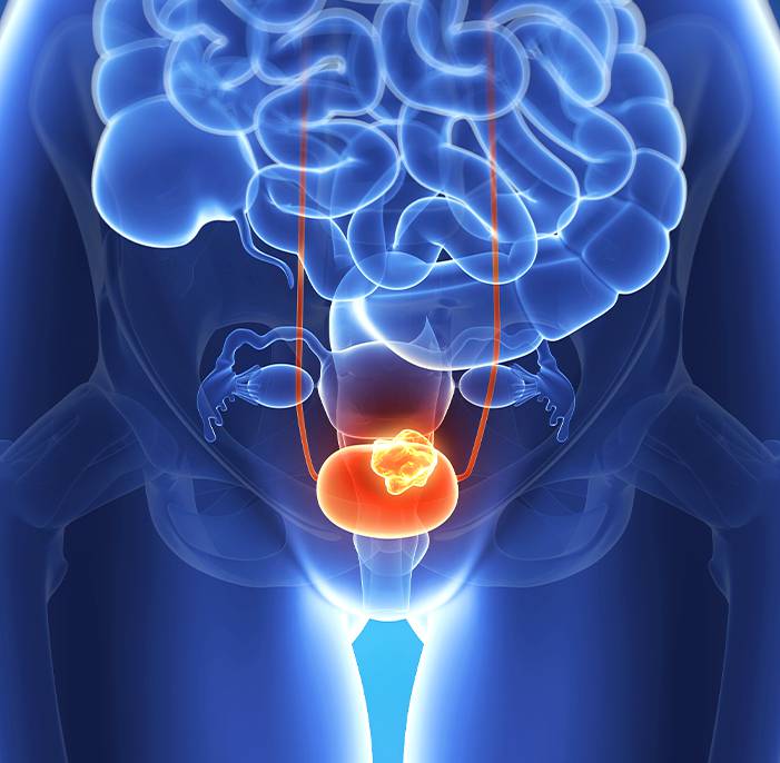 Bladder Cancer Singapore BCG Doctor And Treatment Tan Urology Bladder Cancer Singapore BCG Doctor And Treatment Tan Urology