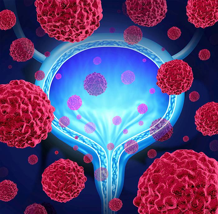 Bladder Cancer Diagnosis Singapore