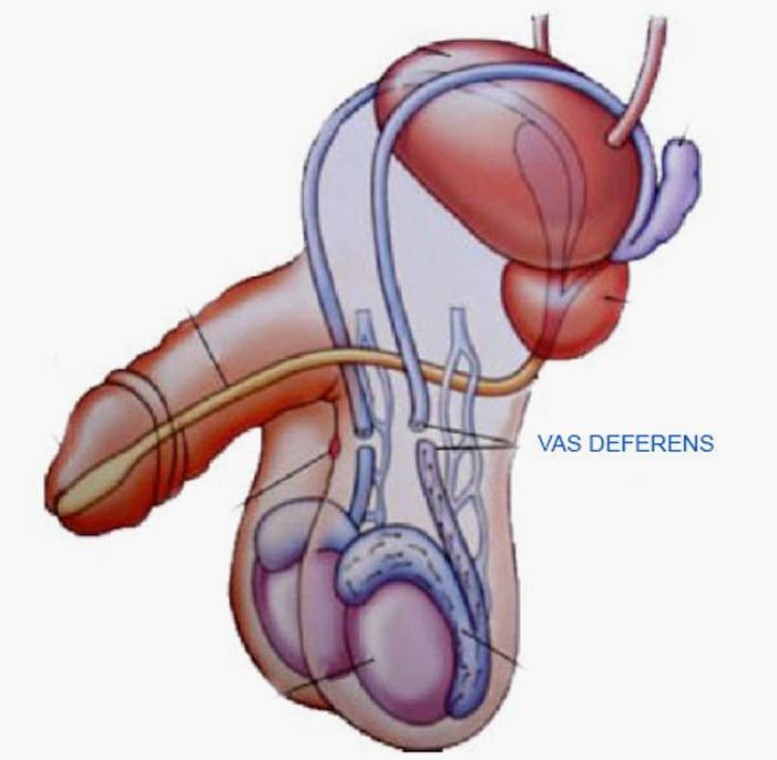 Who is suitable for a Vasectomy?
