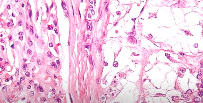 Risk Factors for Kidney Cancer