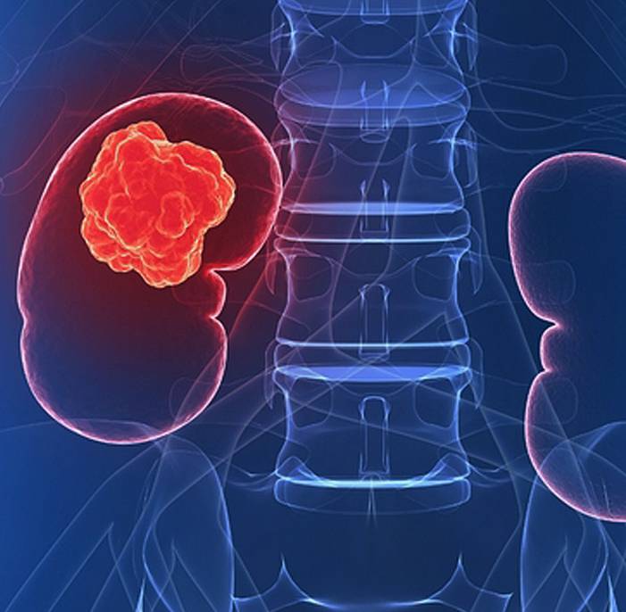 Kidney Cancer Diagnosis & Screening Singapore