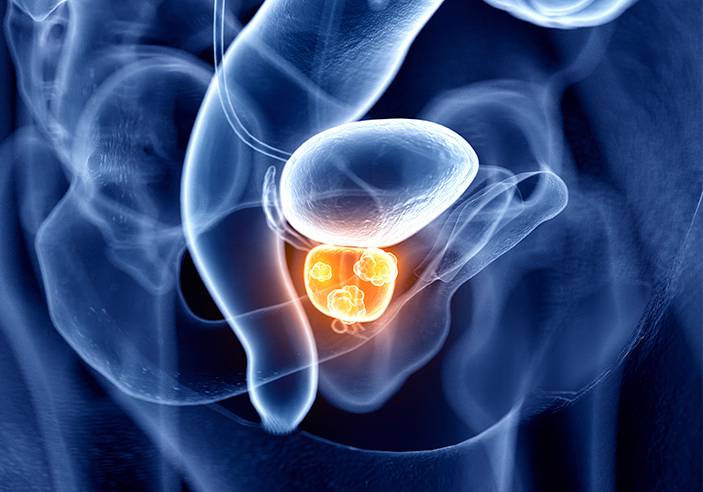 Prostate-Specific Antigen (PSA) for early detection of prostate cancer
