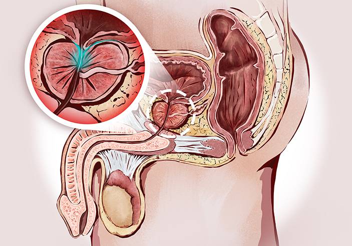 dilis és prostatitis)