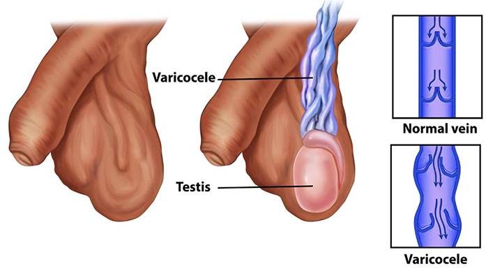 varicoza urolog)