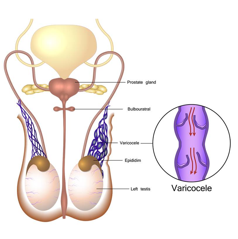 Varicocele  Tan Urology