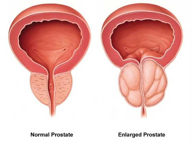 Normal vs enlarged prostate, showing urethra obstruction in the enlarged prostate