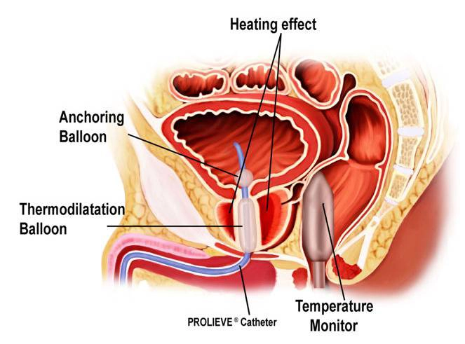Prolieve catheter in enlarged prostate, using microwave heating, a balloon, and temperature monitor