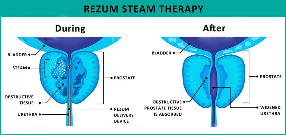 Rezum steam therapy for enlarged prostate, using steam to reduce prostate tissue and relieve symptoms